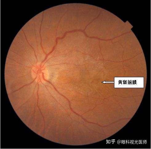 3,视网膜脱离:患者可以表现出眼前黑影遮挡,早期可能会感觉玻璃体内存