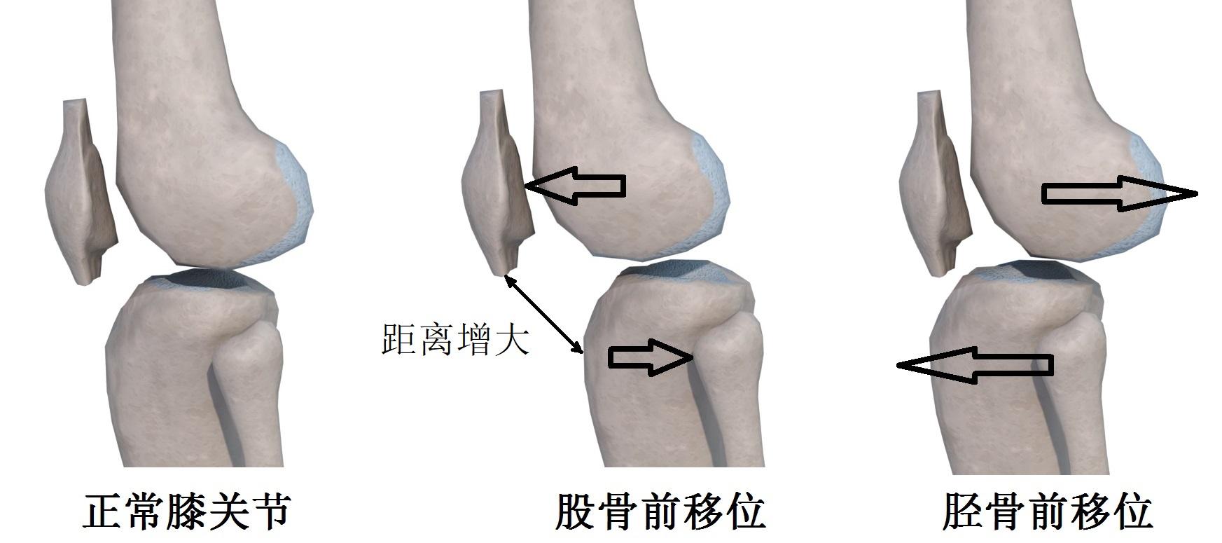 髌韧带,髌尖和胫骨结节压痛,多提示股骨前移位,可能与反复跨步突停及