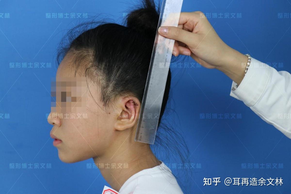 案例分析杯状耳影响学习生活单侧中度杯状耳女孩做手术矫正