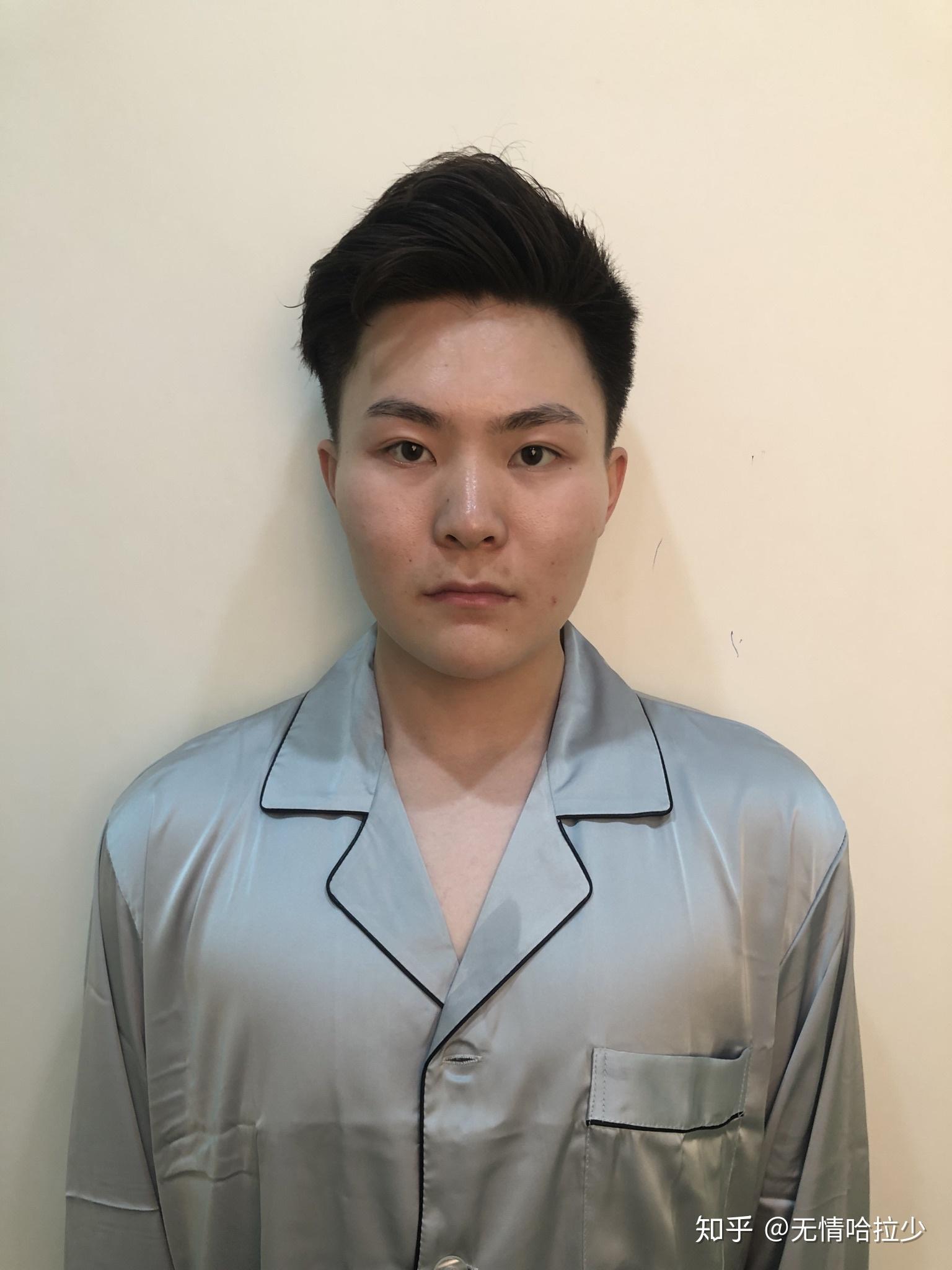 我对自己的脸型不是很满意,颧骨高,而且颧弓外扩,太阳穴看上去有点