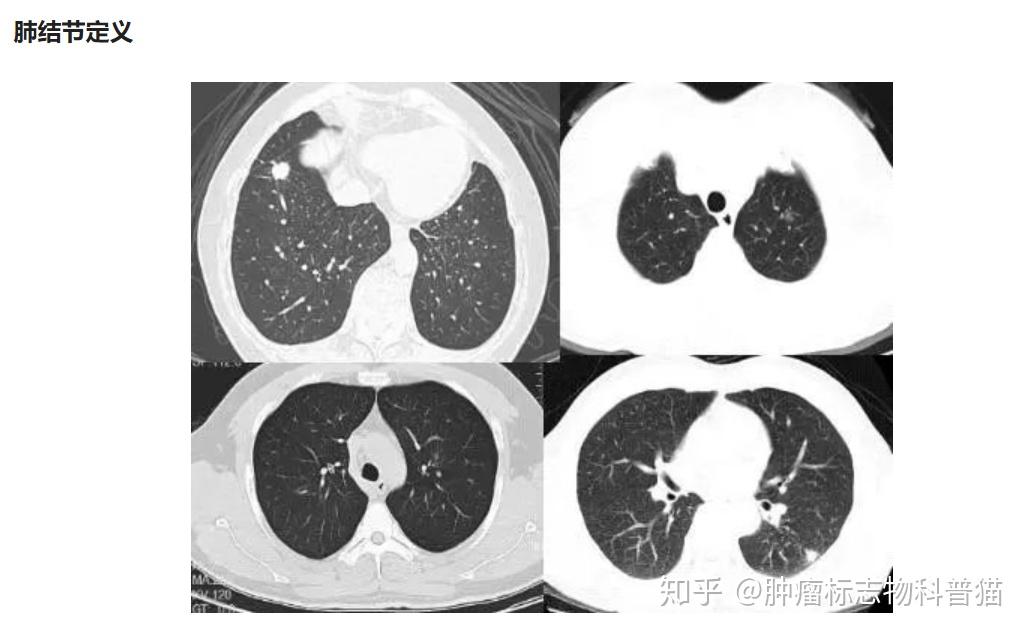 一文講清楚肺部結節肺結節診治中國專家共識2018年版