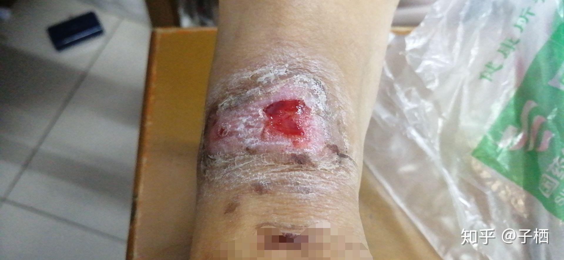 记录烫伤 - 知乎