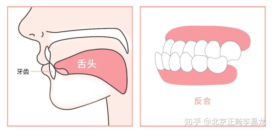 北京牙齿矫正丨舌头位置放错,影响那么大?快看看你的舌头放对位置了吗 - 知乎
