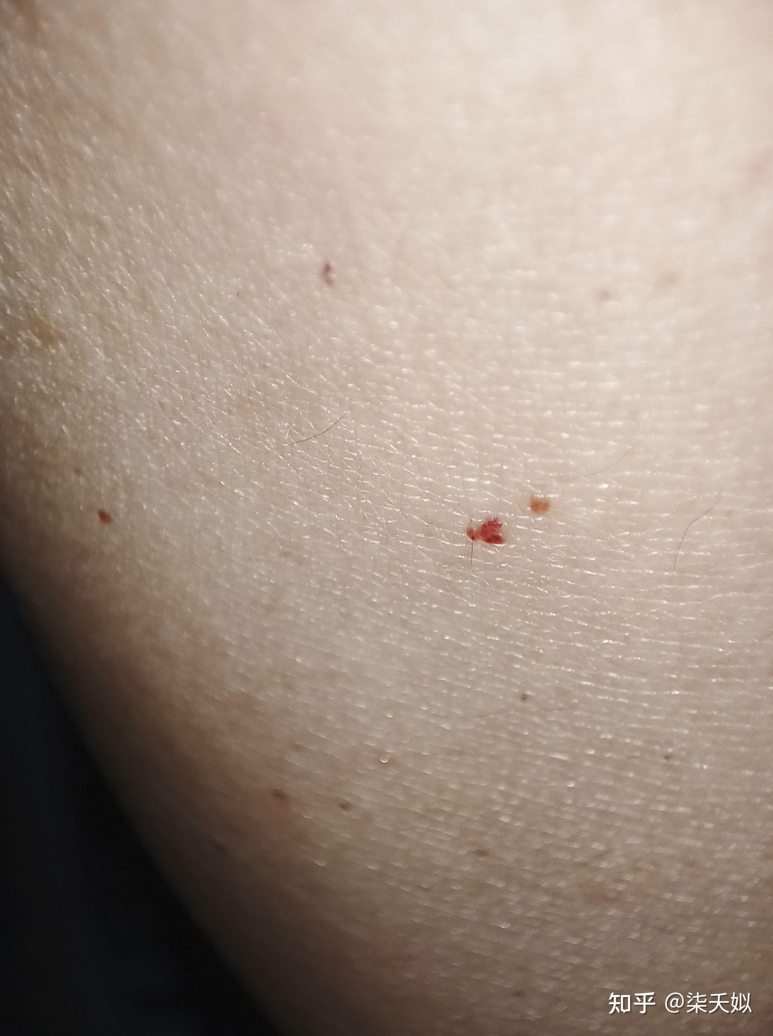 手臂上有很多红色的血点,越来越多,是什么原因呢
