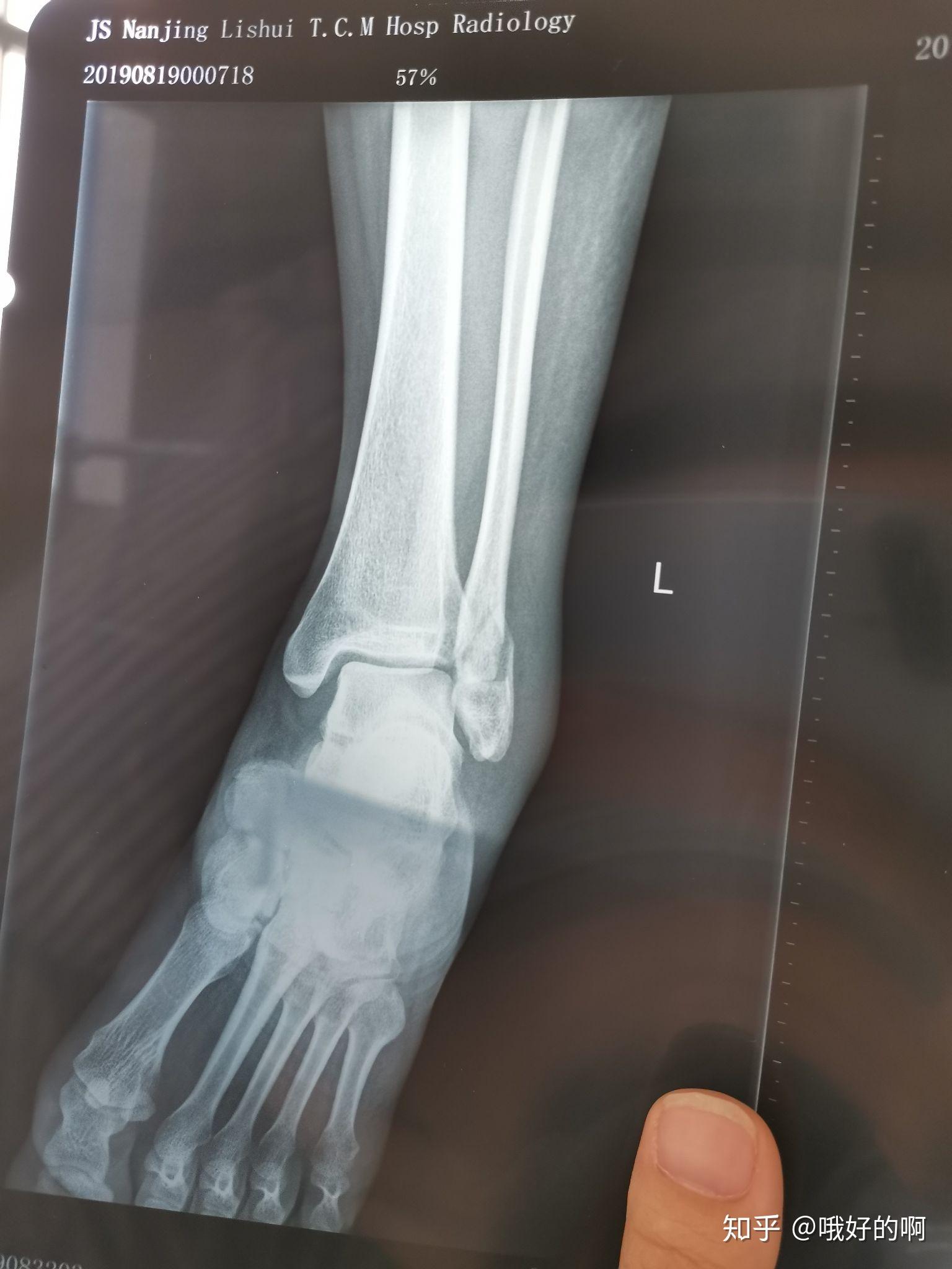 左脚腓骨骨折图片图片