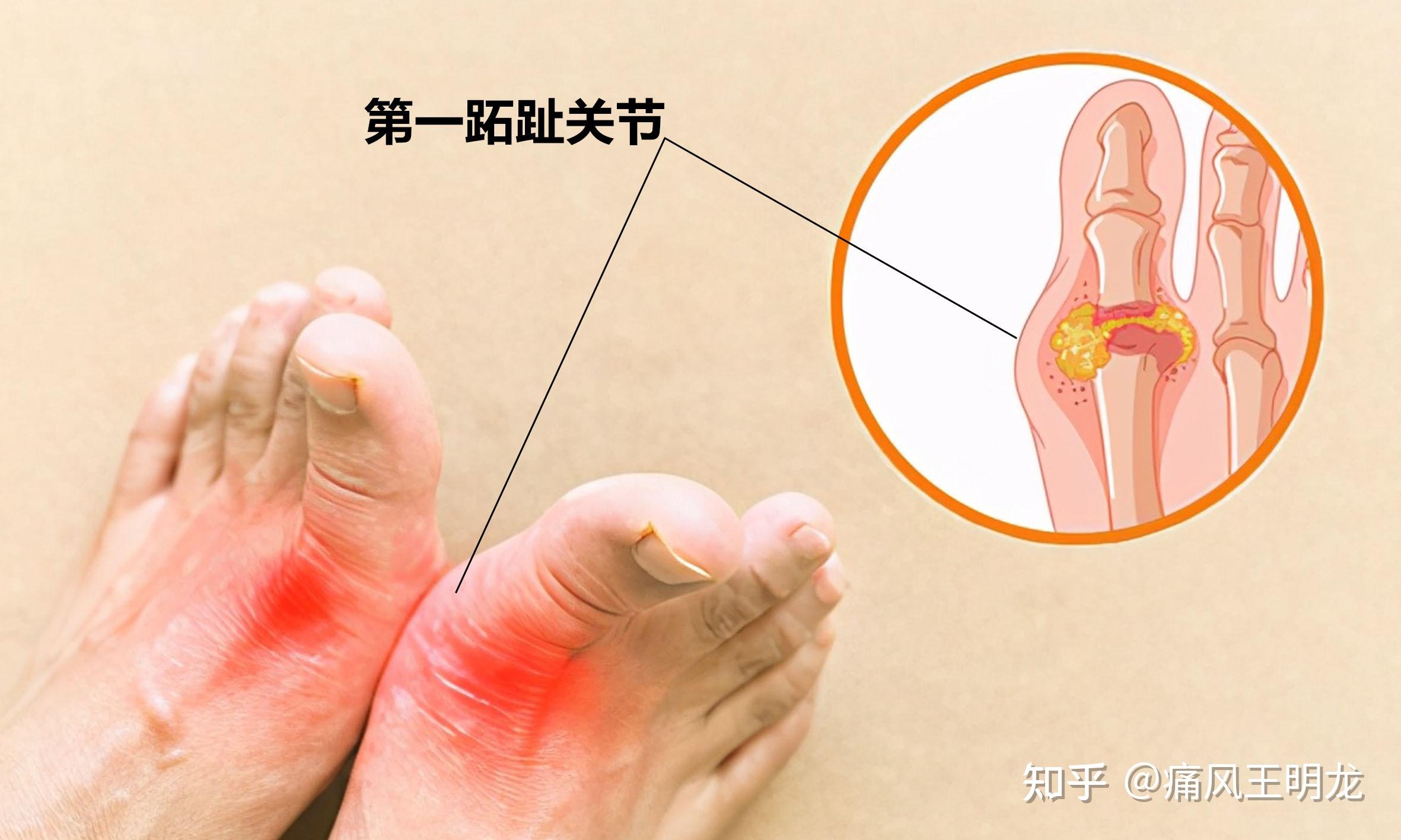 痛风部位图片 位置图图片