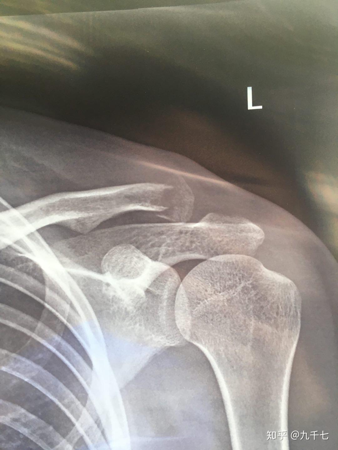 左锁骨远端骨折片子如图请问可以鉴定为十级伤残吗