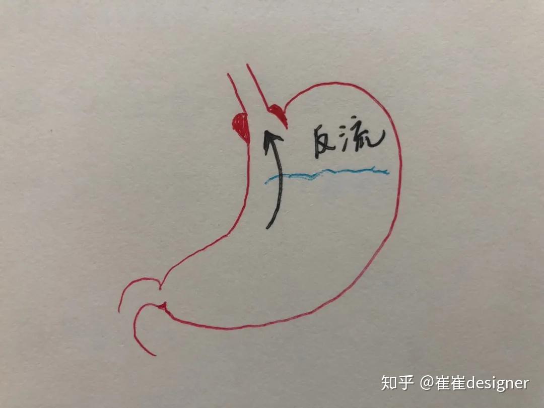 胃反流是很多咳嗽心悸咽炎的罪魁祸首