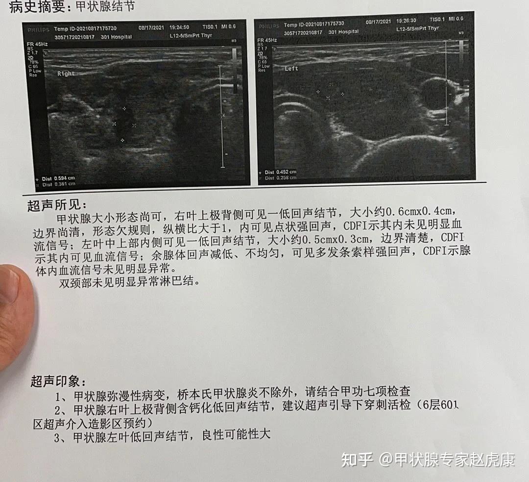 甲状腺穿刺报告解读图片