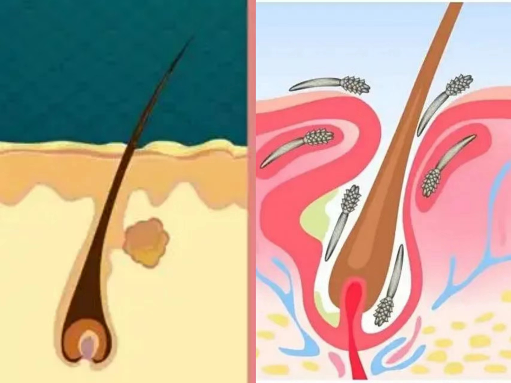 往细里讲,引起睫毛瘙痒的螨虫,叫做蠕形螨,而存在枕头被褥里的螨虫,则