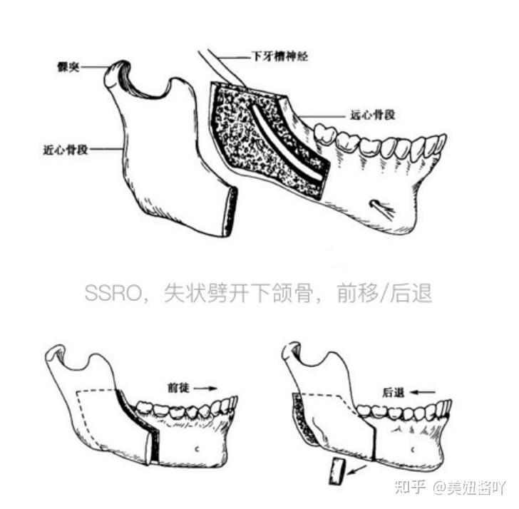2.下颌骨矢状劈术(ssro术式)