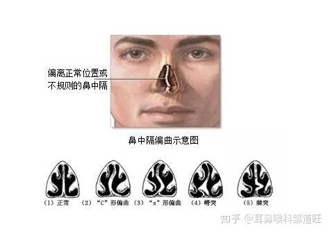 耳鼻喉科邹道旺医生鼻中隔偏曲是怎么回事及有哪些类型