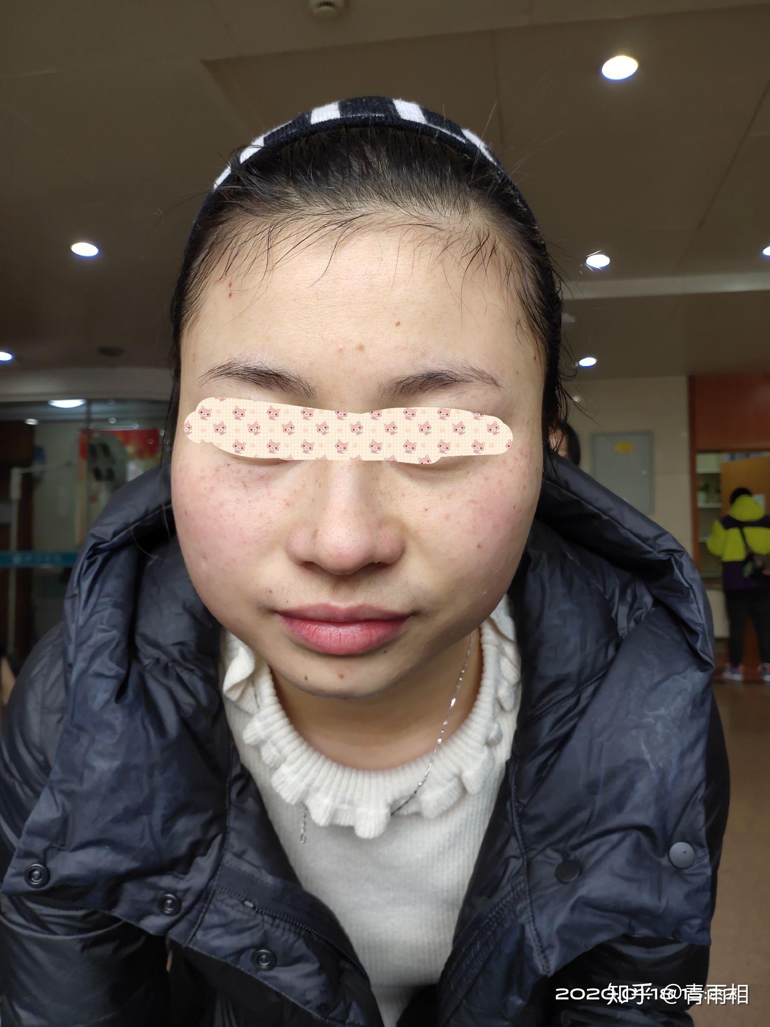 西京医院皮肤科激光祛斑经历 - 知乎