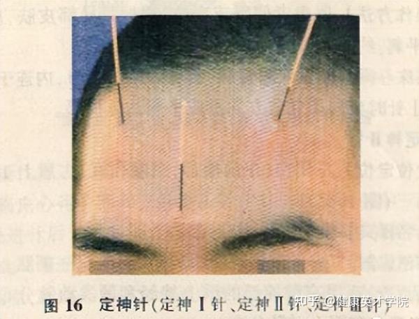 带你了解中医针灸“靳三针”疗法:三针秒杀绝技! - 知乎