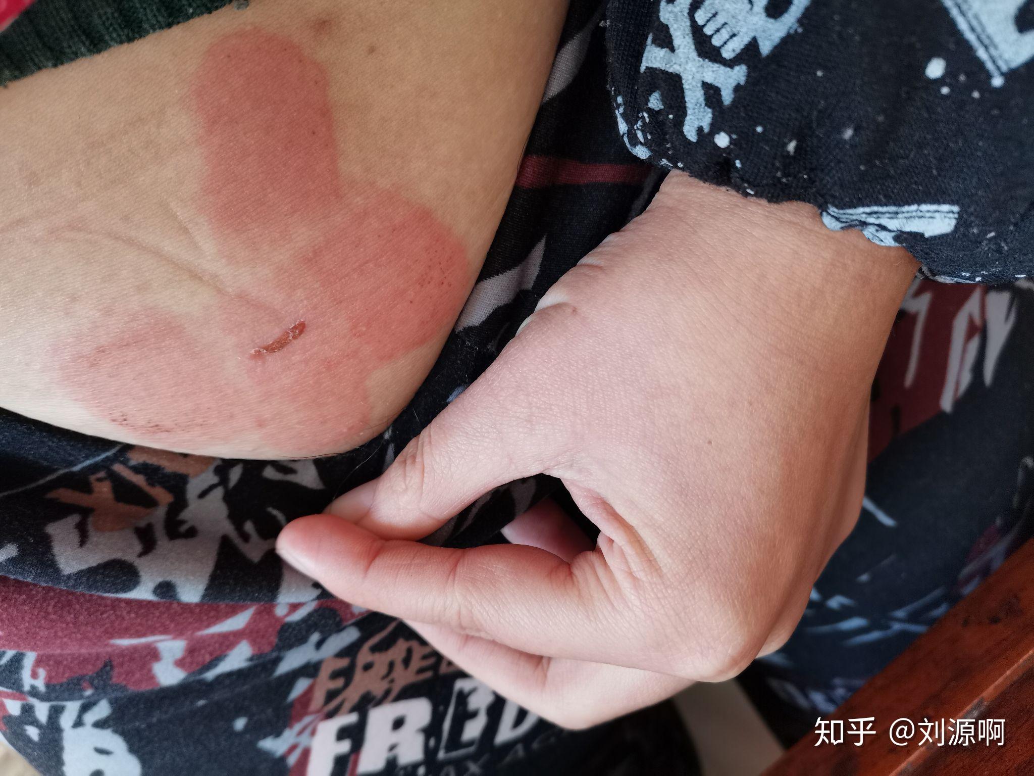 为什么有的人会对创可贴/胶布过敏?过敏原是什么?是过敏吗? - 知乎