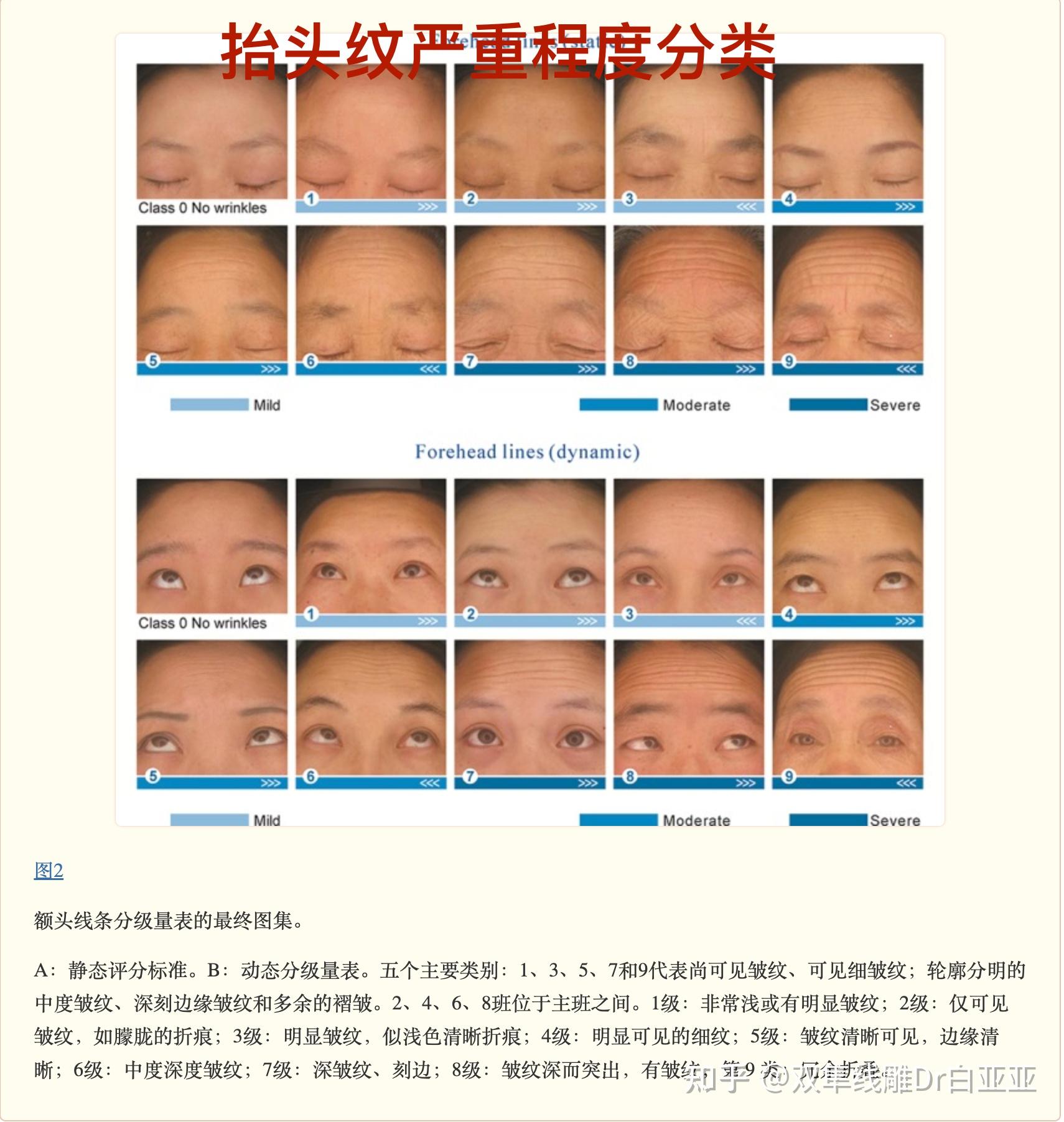 皱纹的分类以及严重程度等级划分 - 知乎