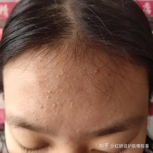 【痘痘肌】闭合性粉刺的修复思路 - 知乎