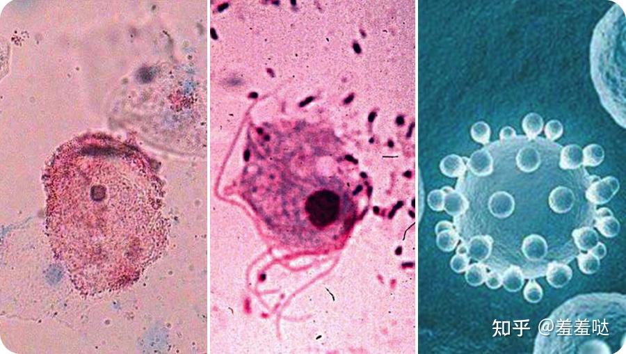 阴道加特纳菌,滴虫,白色念珠菌排在第三位的是hpv检查