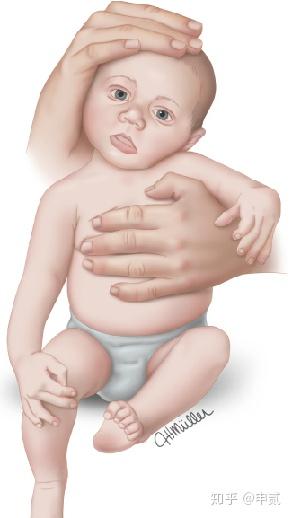 胸锁乳突肌位置婴儿图片