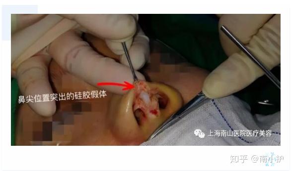 效果看起来是会较好,但重力会跟着时间下滑,假体下滑会最后顶破皮肤