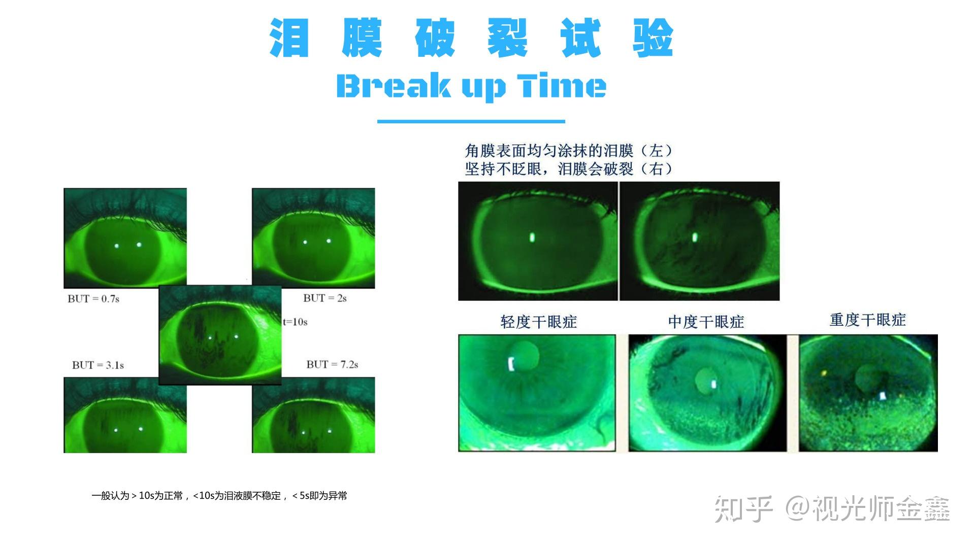 泪膜破裂时间图片