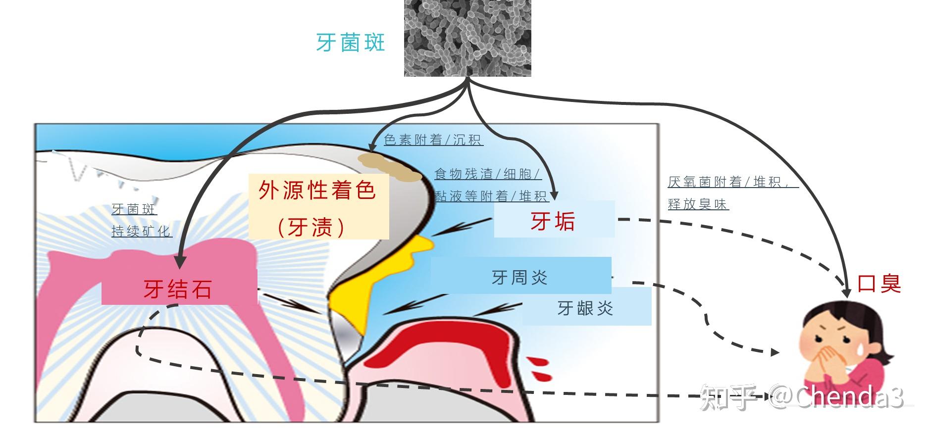 牙菌斑怎么去除？ - 知乎