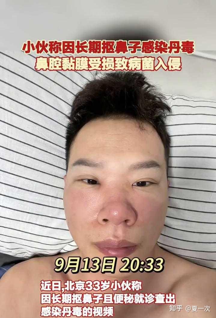 小伙长期抠鼻子感染丹毒!