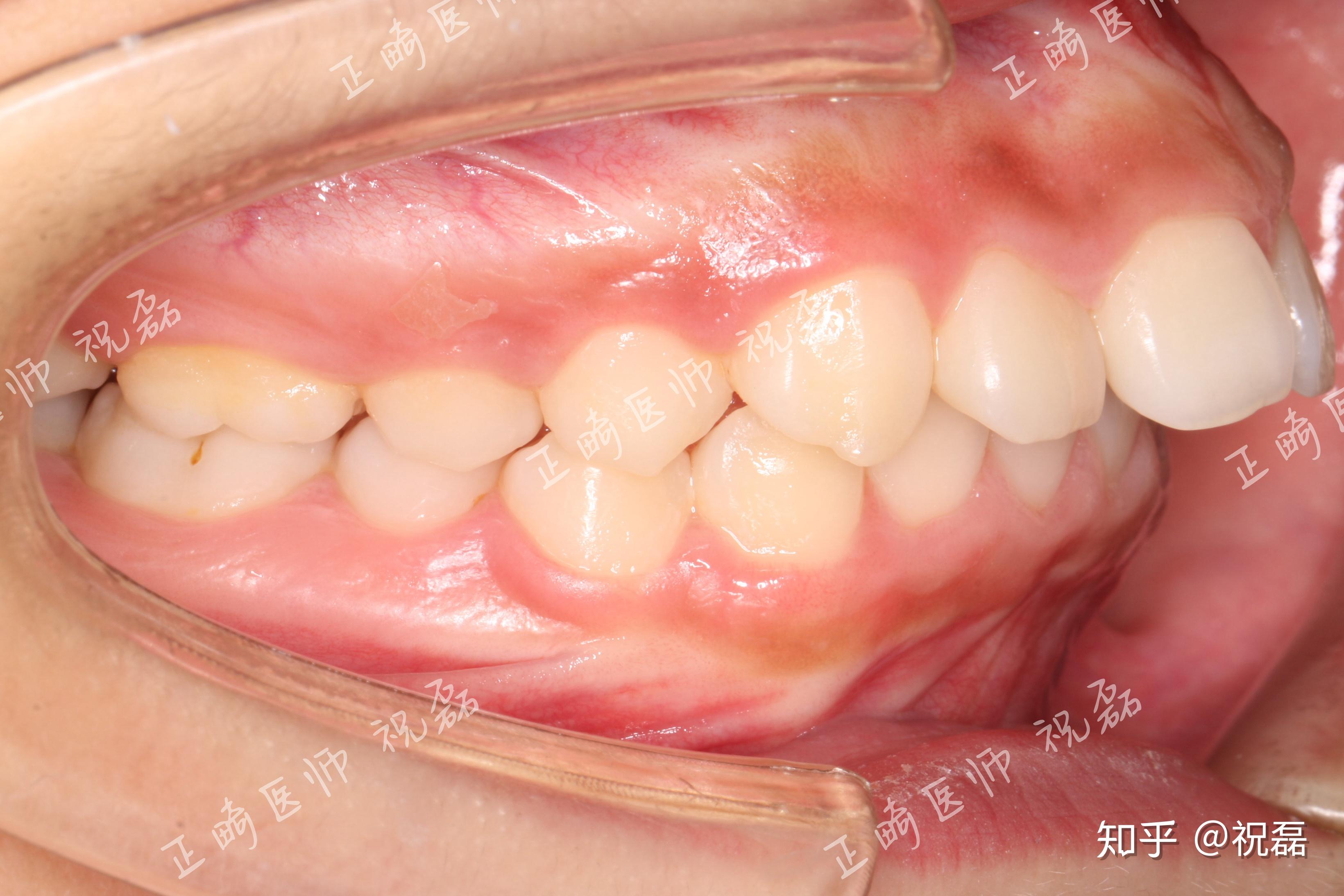 一些,骨凸问题一年就解决了,现在下巴出来一点了,后续还在调整咬合中