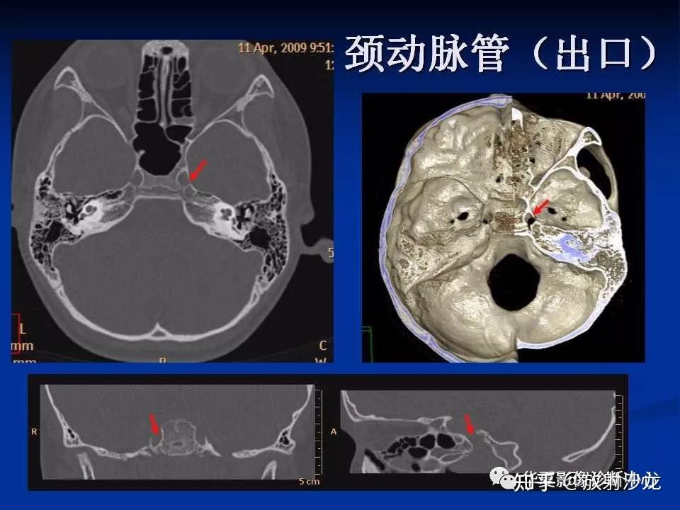 实用、详细的颅底各孔道影像解剖! - 知乎