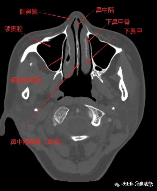 鼻窦 CT 各部位名称解析与鼻腔解剖基础知识 - 知乎