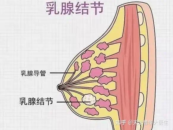 一,乳腺結節到底是什麼病?