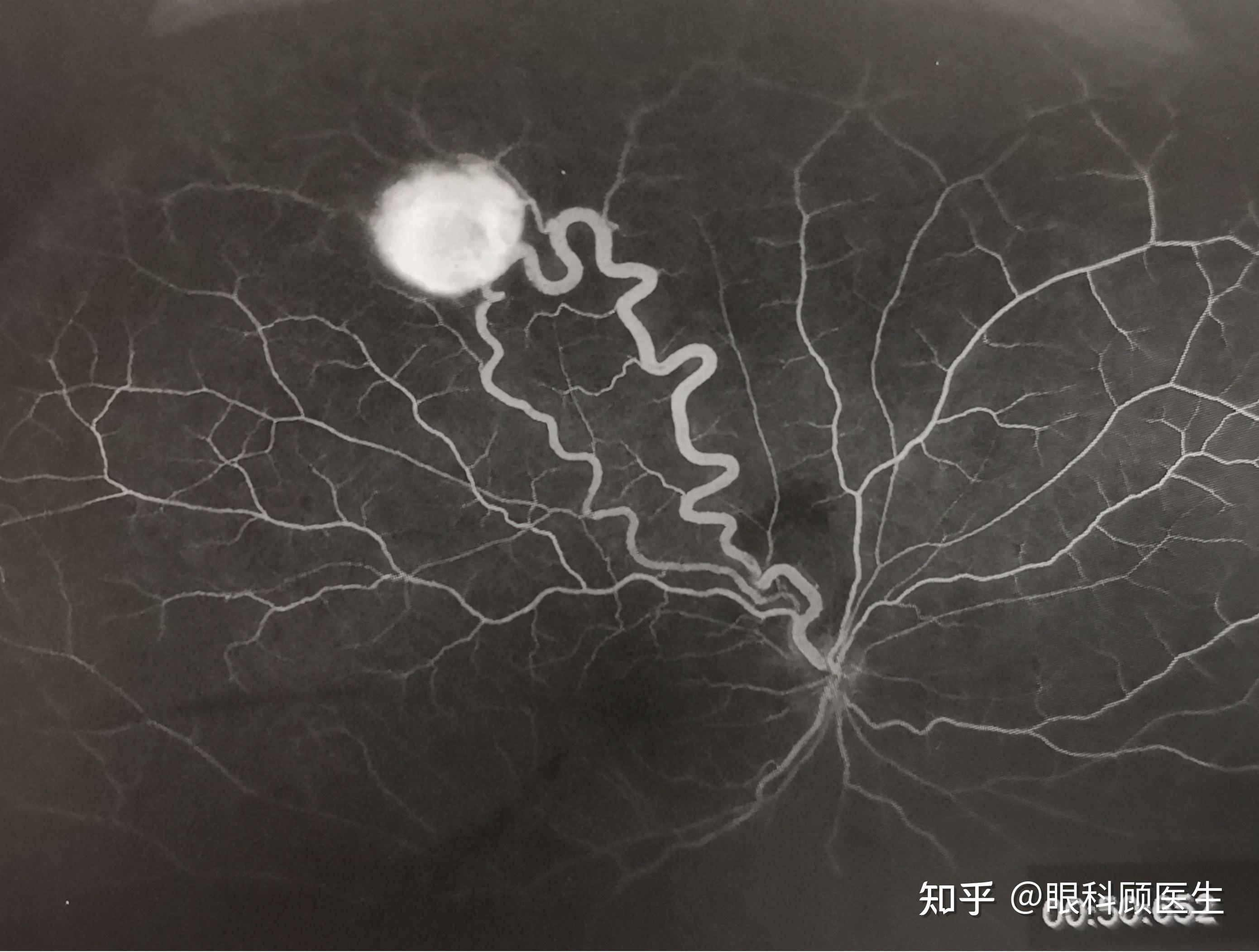 了解一下视网膜毛细血管瘤 - 知乎