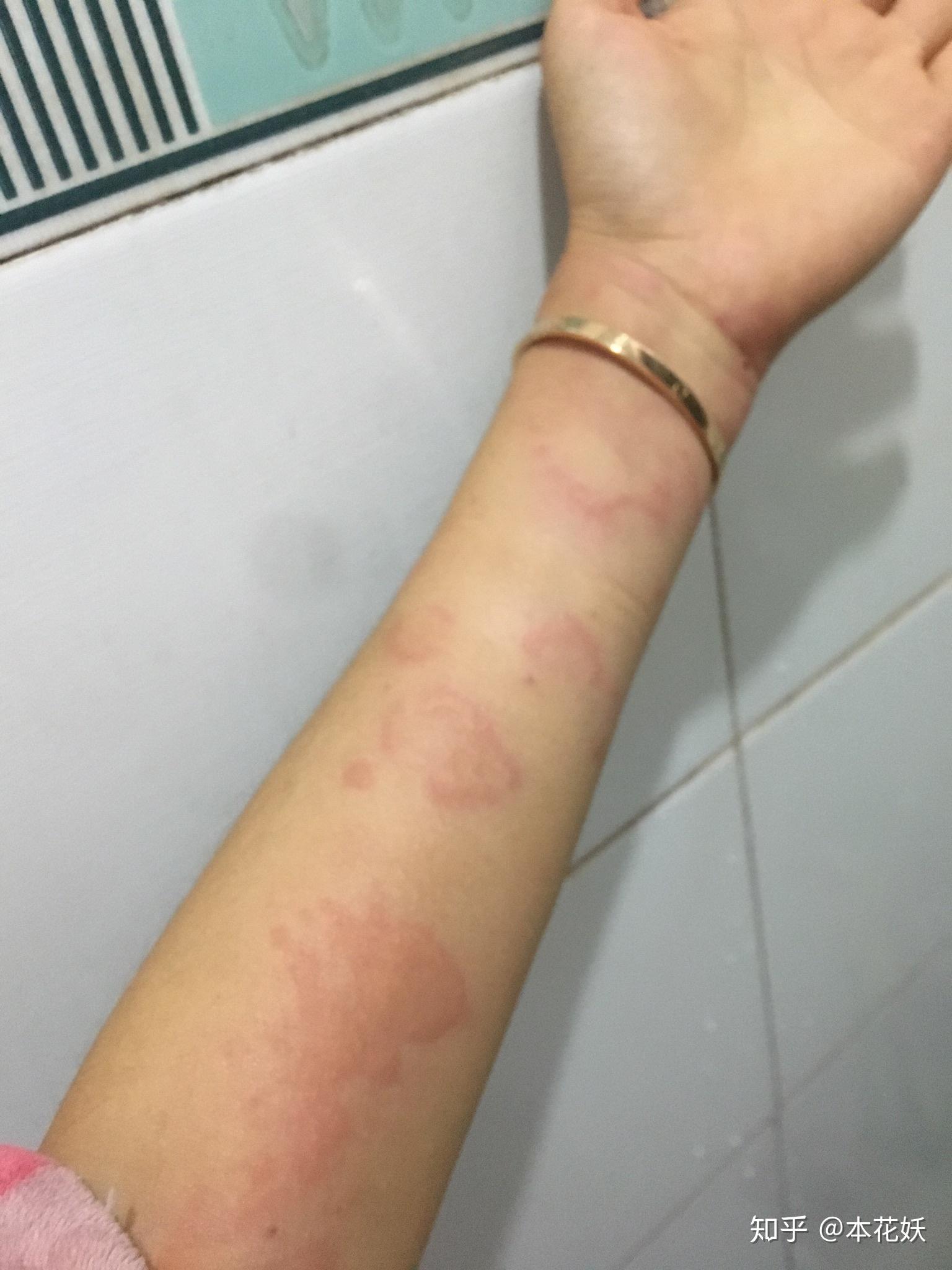 急性荨麻疹攻克之路会续更