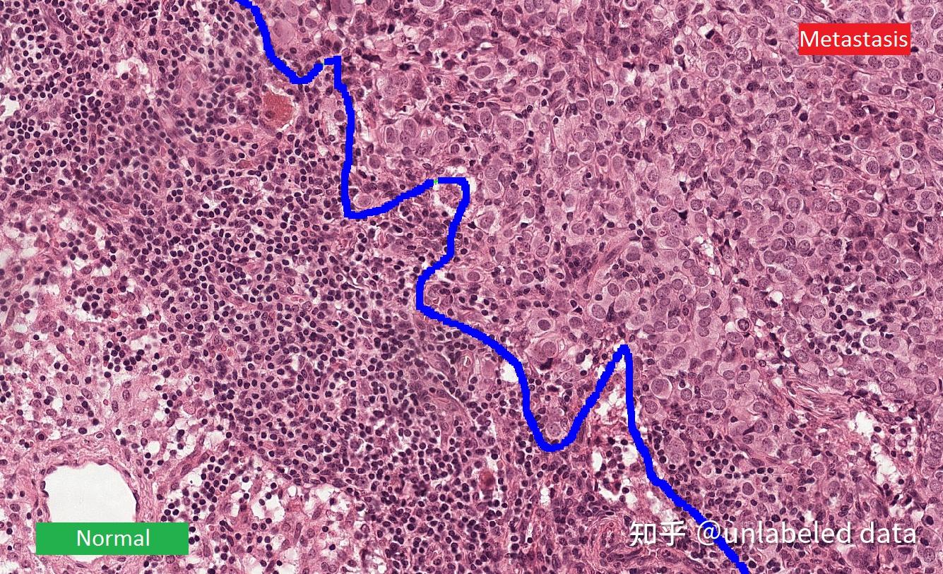 ai病理诊断之乳腺癌诊断初窥