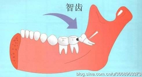 智齿牙龈肿痛 忍一忍就能过去吗 知乎 智齿牙龈肿痛 忍一忍就能过去吗 知乎