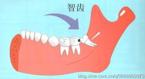 智齿牙龈肿痛 忍一忍就能过去吗 知乎