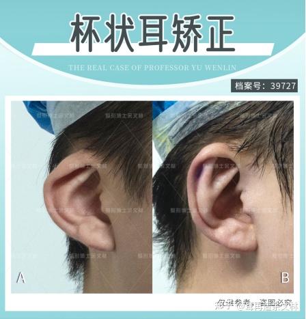 折叠的小耳朵——杯状耳修复后容易反弹? - 知乎