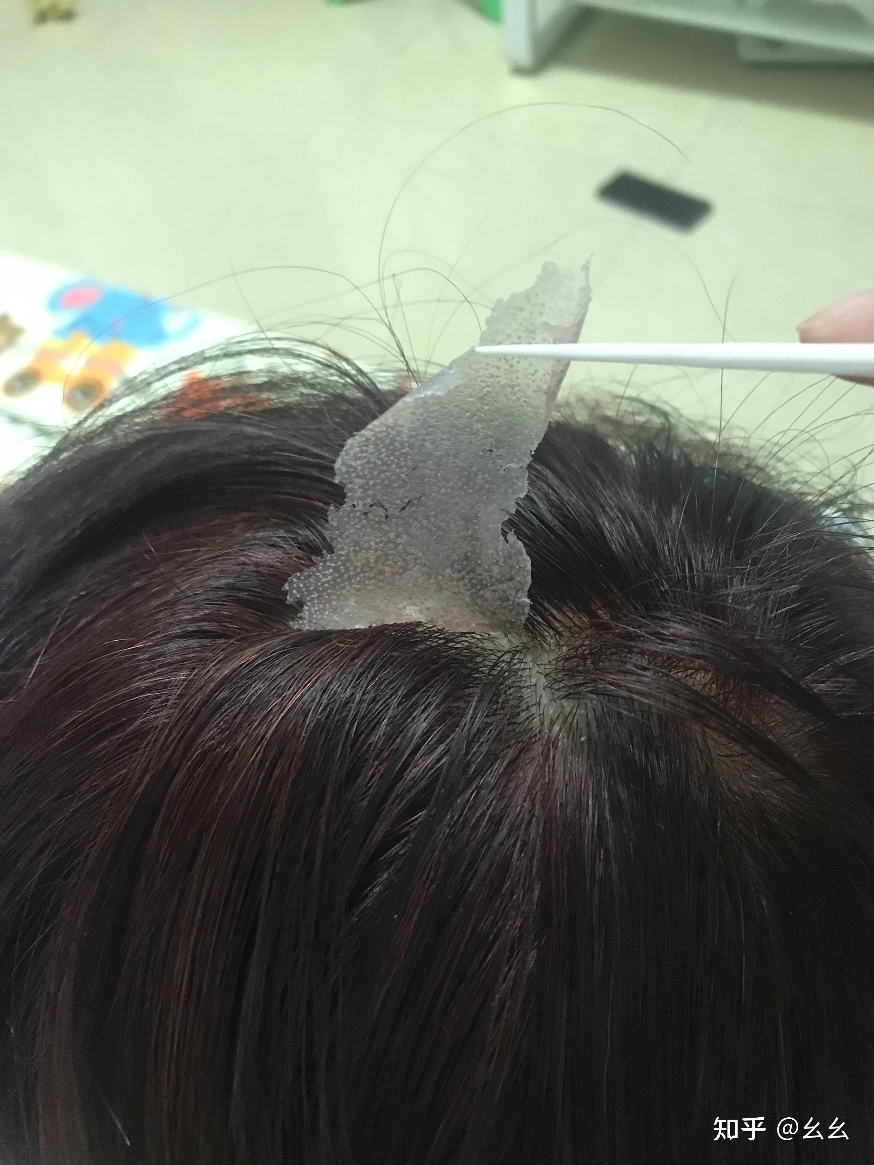 见过的最大头皮屑多大