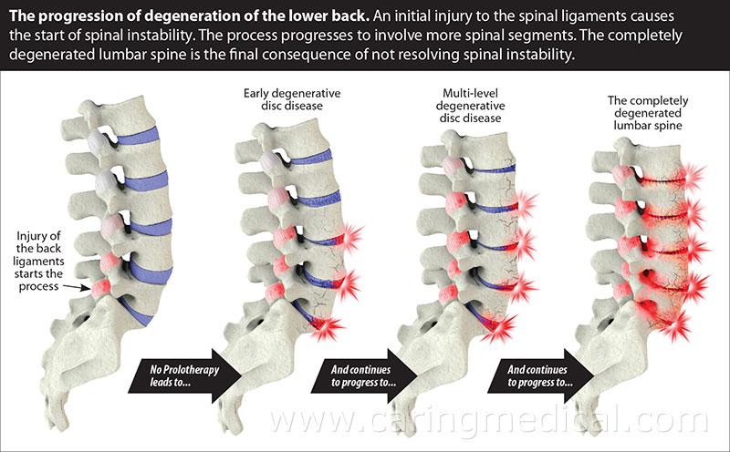 lumbar-spine-l5-s1-exercises-hot-sex-picture
