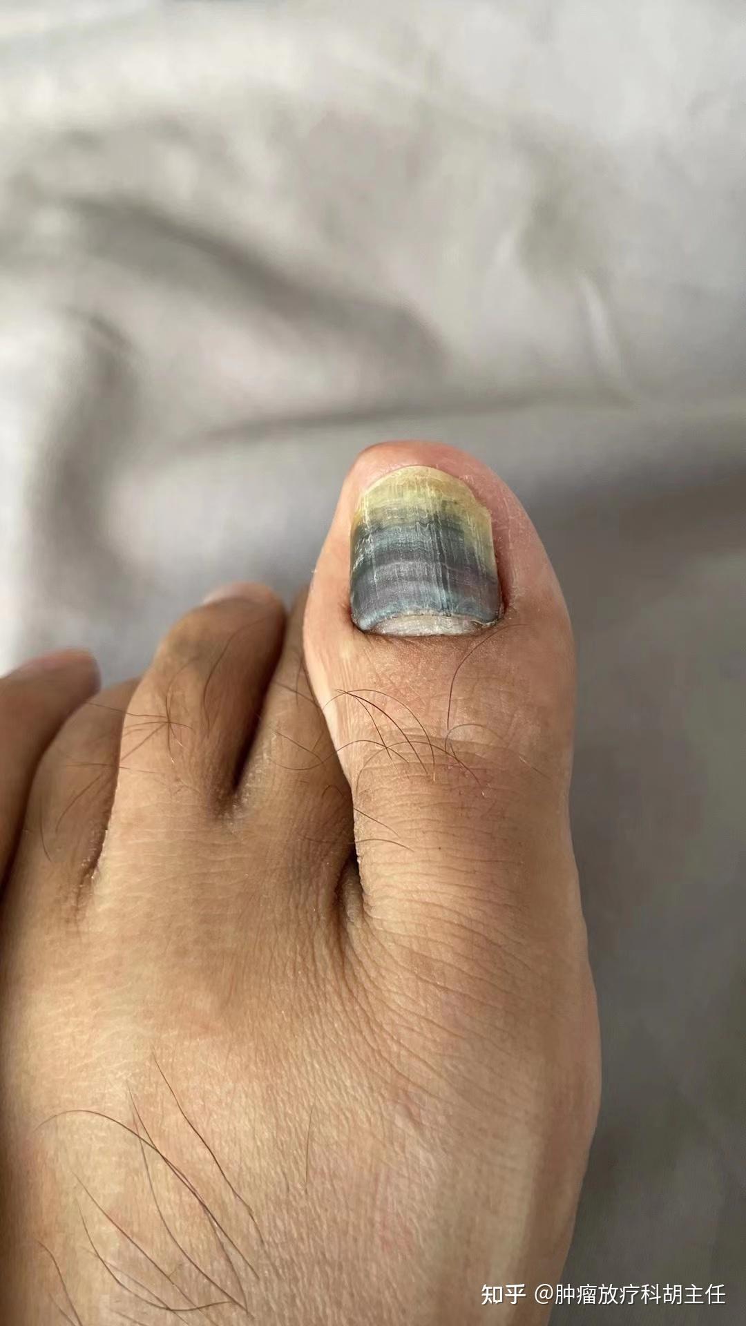 卡培他滨化疗为什么会导致指甲发黑?怎么处理?