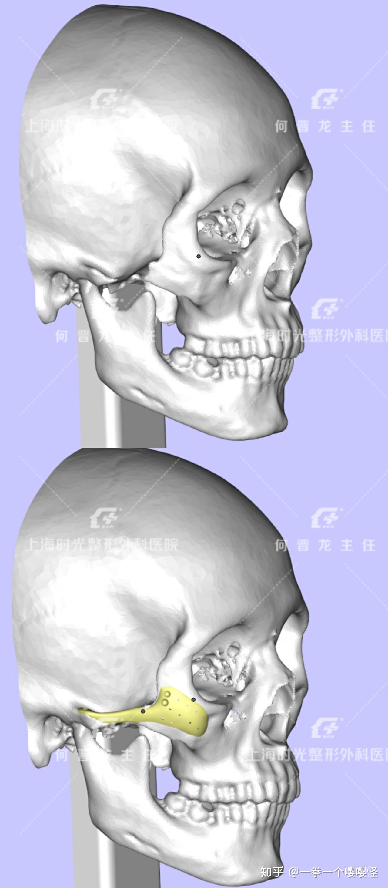 了解韩国颧骨整形手术方式——WJ原辰整形外科医院 - 知乎