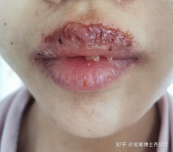 特殊时期特殊部位的疱疹该如何处理