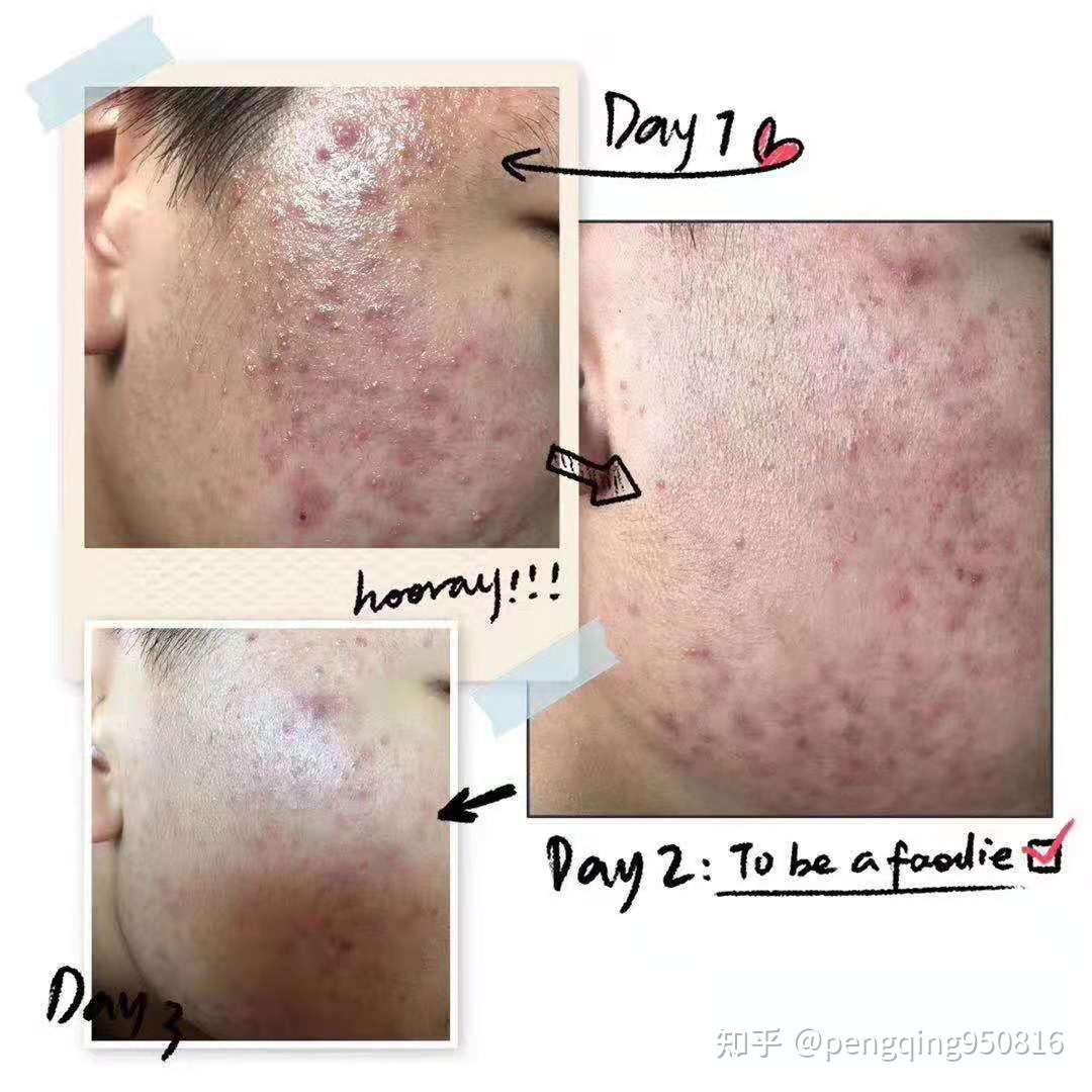 刷酸之后成了敏感肌怎么补救? - 知乎