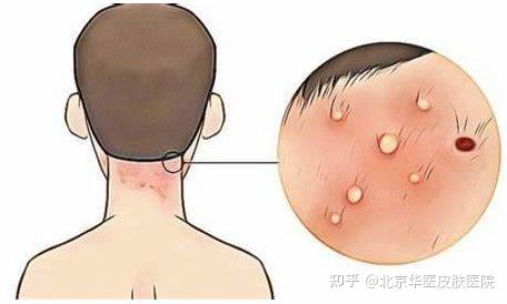 毛囊炎该怎么治疗才好 - 知乎