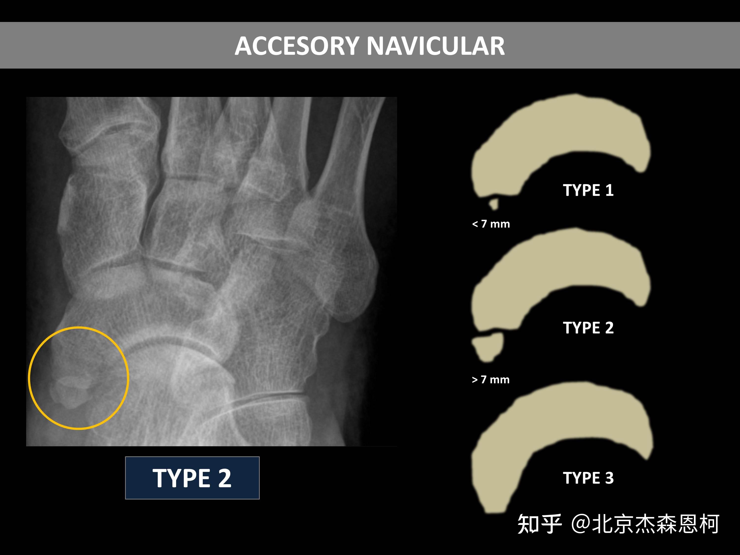 副舟骨疼痛