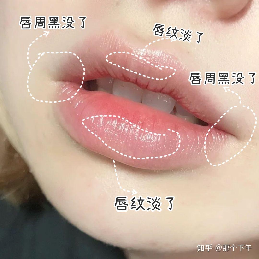 腺样体面容+嘴突+深覆盖+门牙缝过大矫正案例 - 知乎