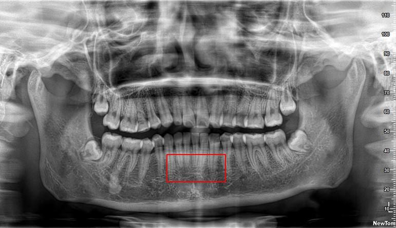 牙根短可以正畸吗