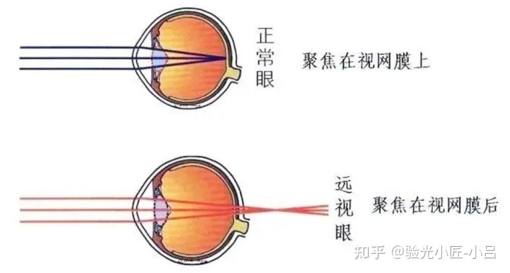 远视眼是因为眼球的前后径过短,物体反射来的光线形成的物像,落在