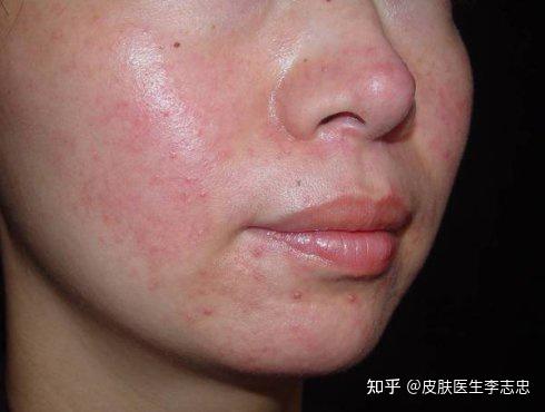 患者面部以炎性红色丘疹,脓疱为主要皮疹,皮脂溢出明显,口臭,口渴,便