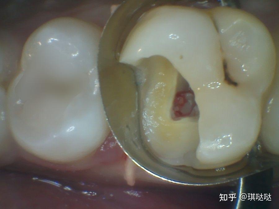 根管治療親身經歷分享